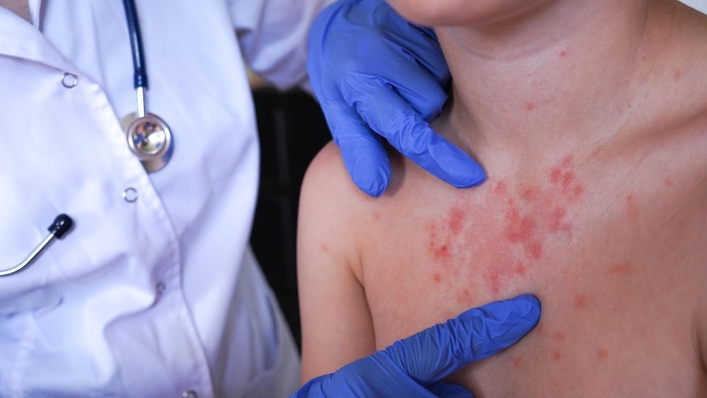 Minnesota's 80 measles cases this year are the most since 1990, health officials say — Apple Valley Health news