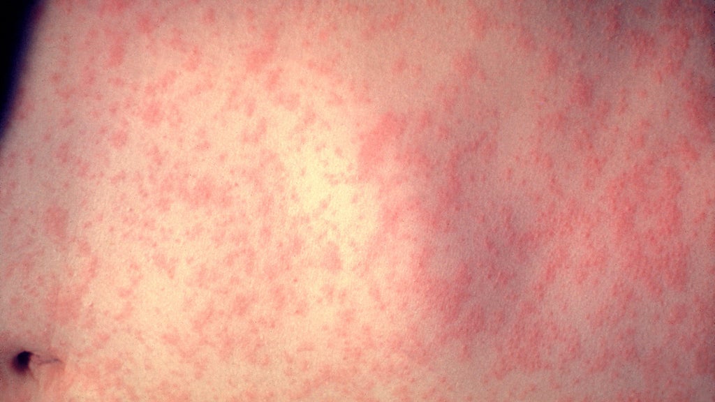 25 cases of measles identified in central, southeastern Minnesota, MDH says — WCCO / CBS Minnesota, Apple Valley Health news
